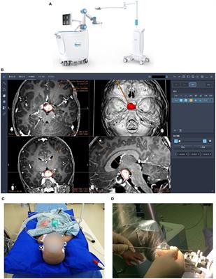 Frontiers | A Bulk Retrospective Study Of Robot-Assisted Stereotactic ...